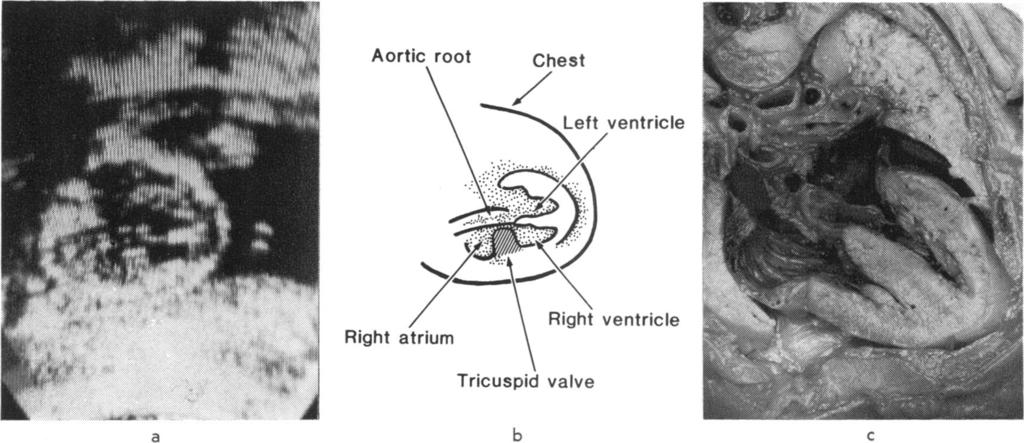 Perhaps because of this, the most easily obtained view in extrauterine life, namely the long axis section of the left ventricle, was the view most difficult to obtain during fetal life.