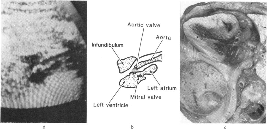 Echocardiographic and anatomical correlates in the fetus Left ventricle Aortic valve 3 b c Fig. 11 An oblique cut in the transverse plane as illustrated in Fig.