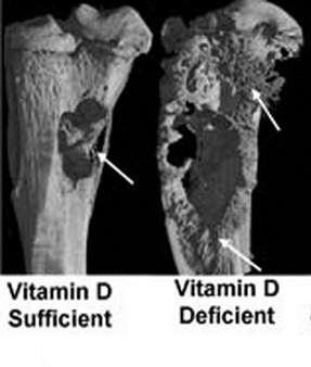 Vitamin D Deficiency Enhances Bone Lesions Caused by Prostate Cancer Cells Plasma 25OHD 98+10 nmol/l 5+2 nmol/l Model for Bone Damage Caused by Cancer Metastasis Nude
