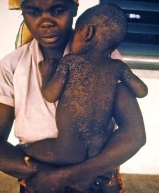 Uganda Measles Case Study Authors: David Bishai and Sasmira Matta Background: What is measles? How is Uganda affected?