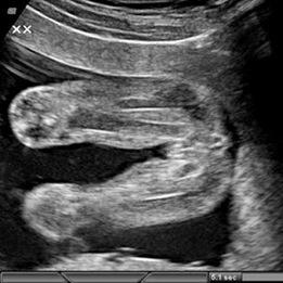 Female Development Fetal Development: ovaries develop in abdomen - descend but