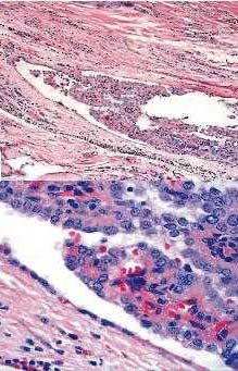Hurthle cell neoplasm Vascular invasion Lack of colloid
