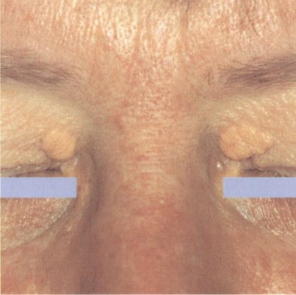 Xanthelasma By