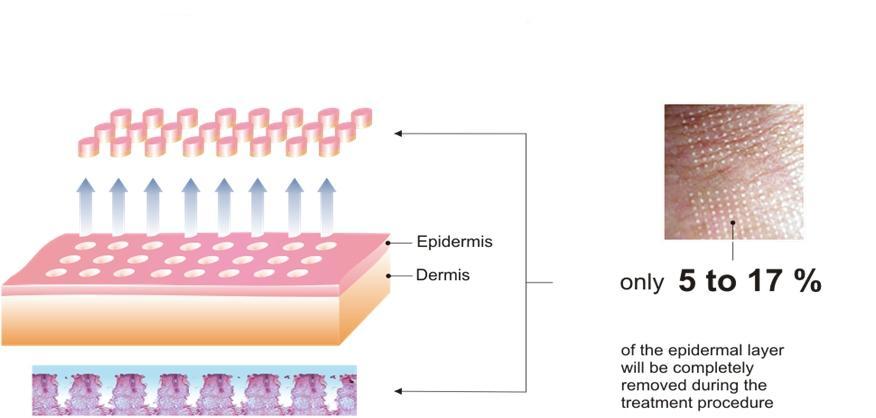 MicroSpot Superfractional Extension Set involvement of the whole epidermis in the