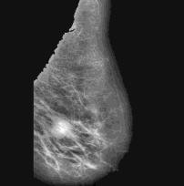 Initially the mammogram images are poor in contrast and consist of many artifacts.