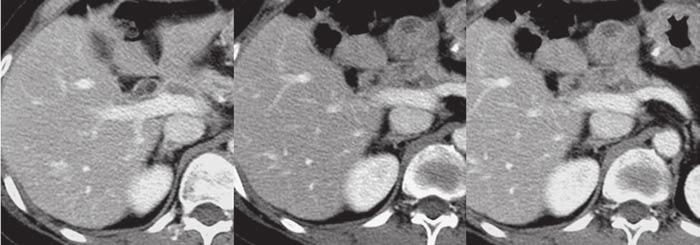 CT Findings of Afferent Loop Varices Fig. 3 43-year-old woman with afferent jejunal loop varices.