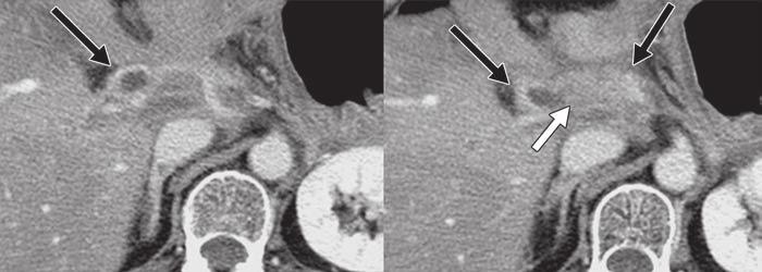 B, Axial portal venous phase CT images obtained 48 months after surgery show abnormally engorged and dilated venous structures (black arrows) in jejunal loop of choledochojejunostomy site.