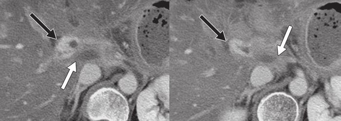 C, Axial portal venous phase CT images obtained 51 months after surgery shows more prominently engorged and dilated venous structures (black arrows) in jejunal loop of choledochojejunostomy site.