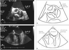 Calcification and immobilization of valve leaflets Healthy Aortic Valve Closed Open Stiffening and narrowing Valve opening Cardiac output Diseased Aortic Valve Closed Open Aortic Stenosis: Diagnosis