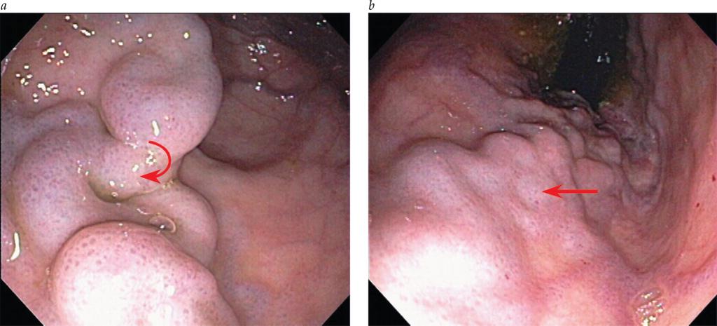 gastro Secondary Prophylaxis No control trials have determined the preferred therapy for the prevention of recurrent gastric variceal bleeding.