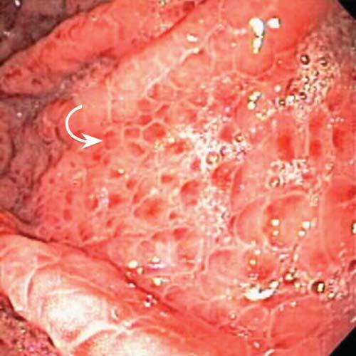 gastro portal hypertension 13 Figure 15 Endoscopic image of severe portal hypertensive gastropathy. Note the cobblestone appearance (arrow) with red signs on the cobblestone. nervous system.
