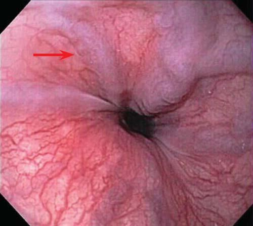 gastro portal hypertension 3 Figure 1 Endoscopic image of small esophageal varices (arrow) less than 5 mm in diameter.