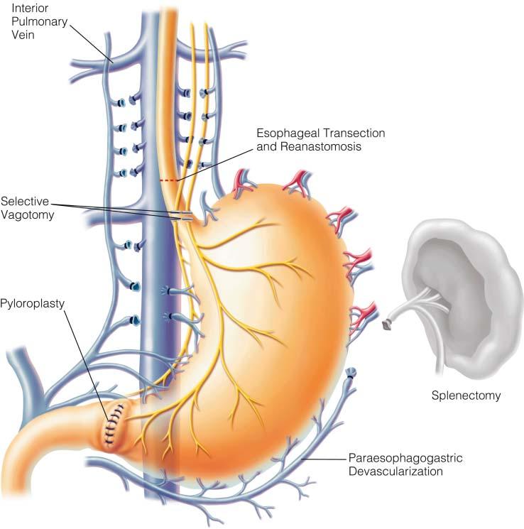 gastro portal hypertension 6 devascularization of the greater curvature of the stomach and the upper two thirds of the lesser curvature of the stomach and circumferential devascularization of the