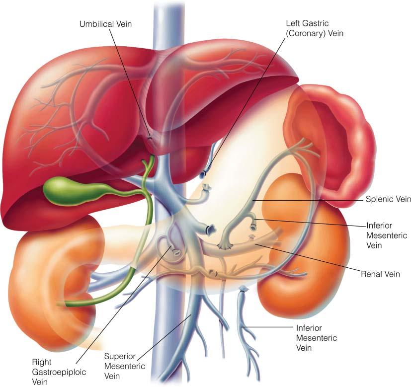 gastro portal hypertension 7 Figure 7 The distal splenorenal shunt (DSRS) diverts portal flow from the spleen and short gastric veins into the left renal vein.