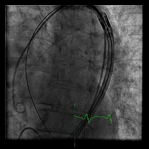 Tracking Over Aortic Arch