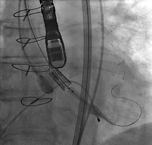 Crossing Native Valve Flex catheter should be fully flexed to pull wire out of commissure Always keep delivery system and SAPIEN valve directly adjacent to support crossing the native valve DO NOT