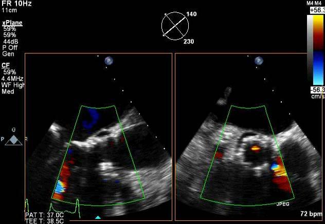 Assessing Aortic Regurgitation: TEE 2D TEE provides better visualization than TTE