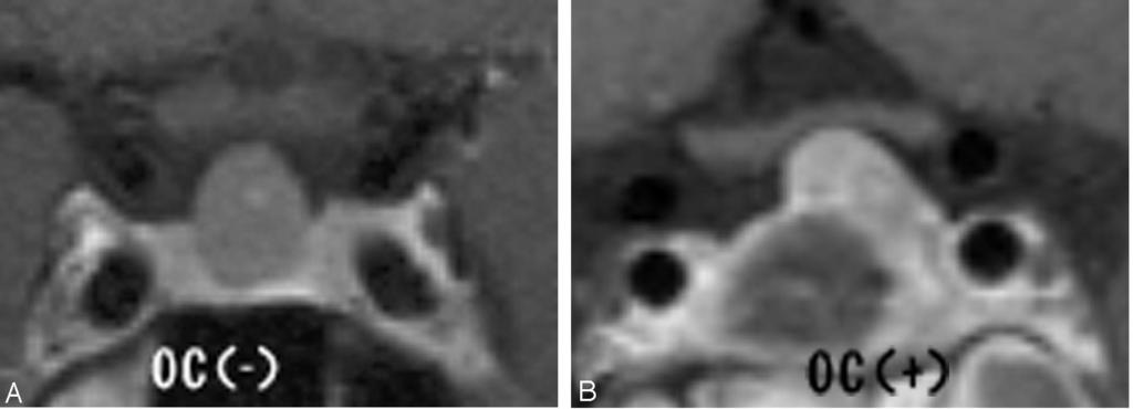 Fig 1. Degree of optic chiasmal compression. A, No compression to optic chiasma ( ). B, Compression of less than half of the optic chiasm ( ). C, Compression with marked thinning ( ).