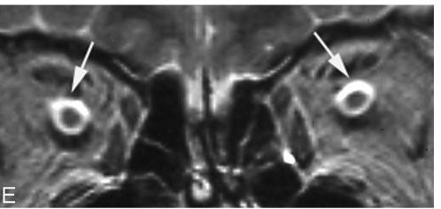 B, Hyperintensiy of the optic nerve was not shown (arrows) on the initial examination. C, Right-side perioptic subarachnoid space dilated slightly on the initial examination (arrow).