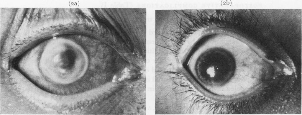 lamellar graft grafts four peripheral iridectomies were performed, one in each quadrant. The anterior chamber was flushed continuously with sterile normal saline containing framycetin (0-5 ml.