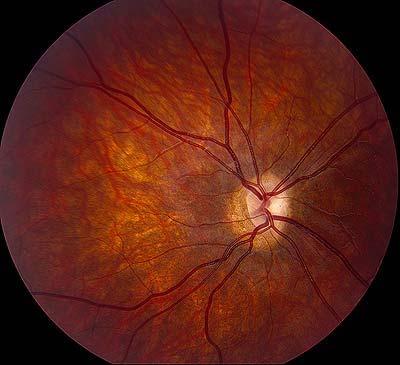 Communicating with patients about alternative therapies: A case of optic nerve hypoplasia Chief Complaint:14 year old male with poor vision since birth History of Present Illness: An otherwise