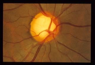 54 The Open Ophthalmology Journal, 9, 3, 54-58 Evaluating Optic Nerve Damage: Pearls and Pitfalls Open Access Paul J. Mackenzie * and Frederick S.