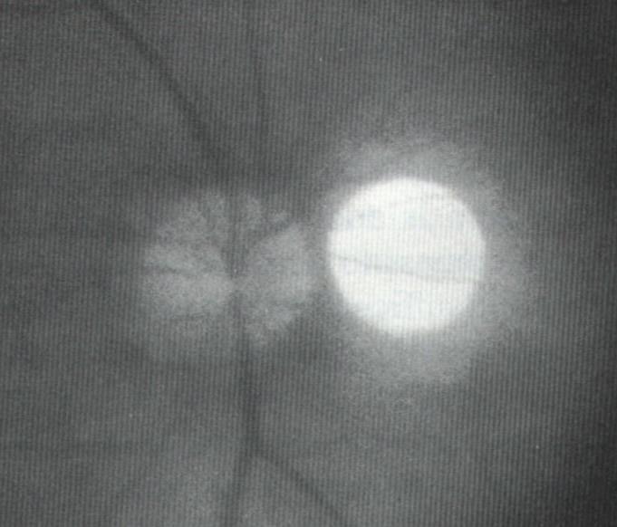 Techniques to Measure Disc Size Direct ophthalmoscope 5 o degree spot 1.