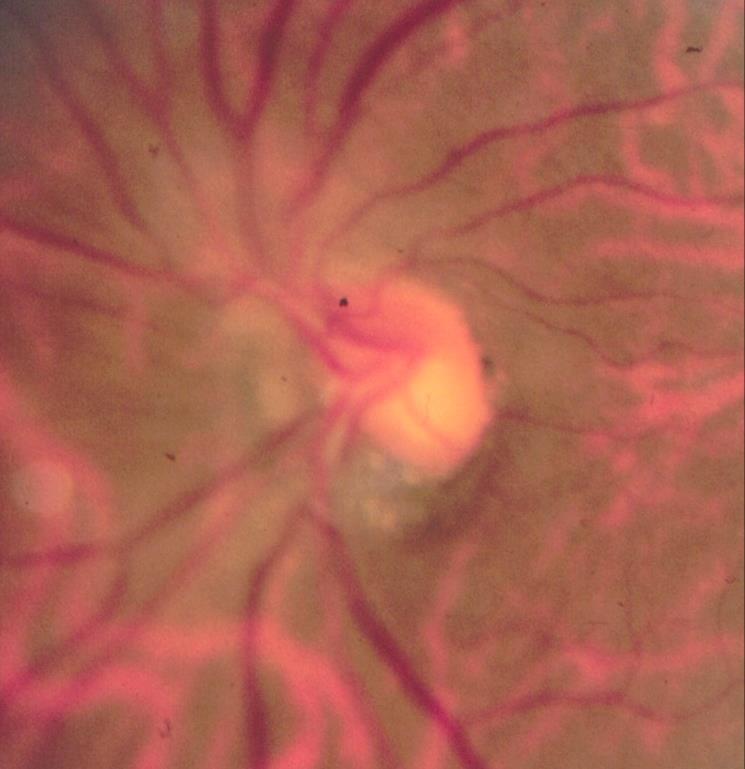 Myopic Tilted Discs May be difficult to interpret May have