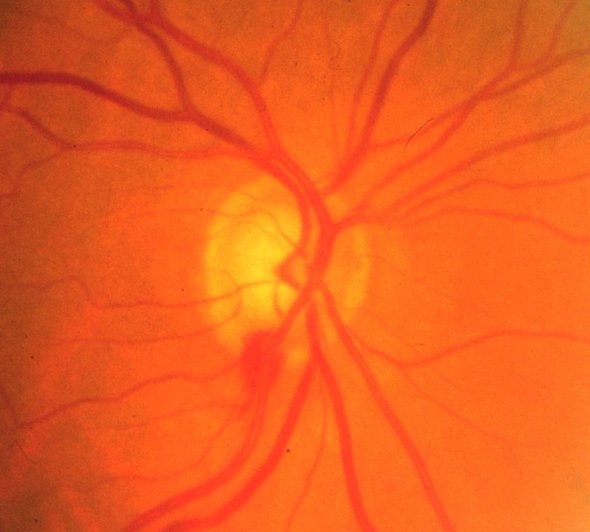 Optic Disc Hemorrhages Giant red