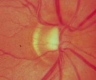 alternation flicker to detect optic nerve