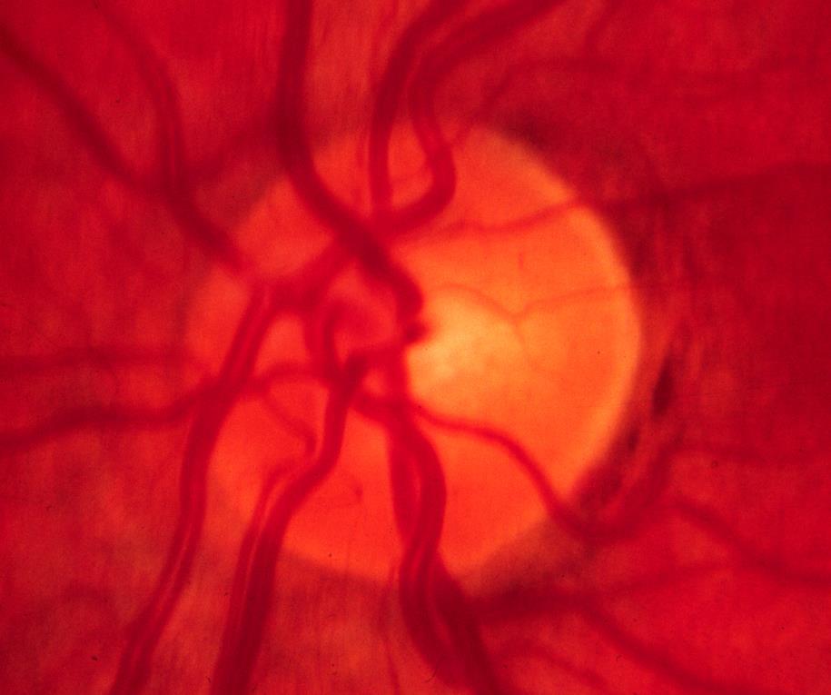 Normal Optic Nerve Vertically oval ISN T Rule