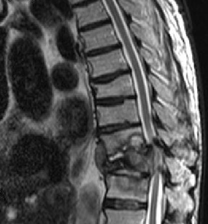 Figure 1. CT scan showing T10 osteomyelitis, sagittal plane. Figure 2. CT scan showing T10 osteomyelitis, transverse plane. biopsy of the T10 vertebral body, which showed no evidence of malignancy.