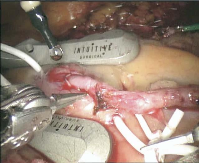 The left internal mammary artery to the left anterior descending artery anastomosis using s-18 U-CLIP (Medtronic, Inc).