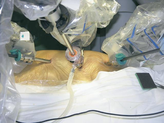 External defibrillator patches were placed to subtend the maximum cardiac mass.