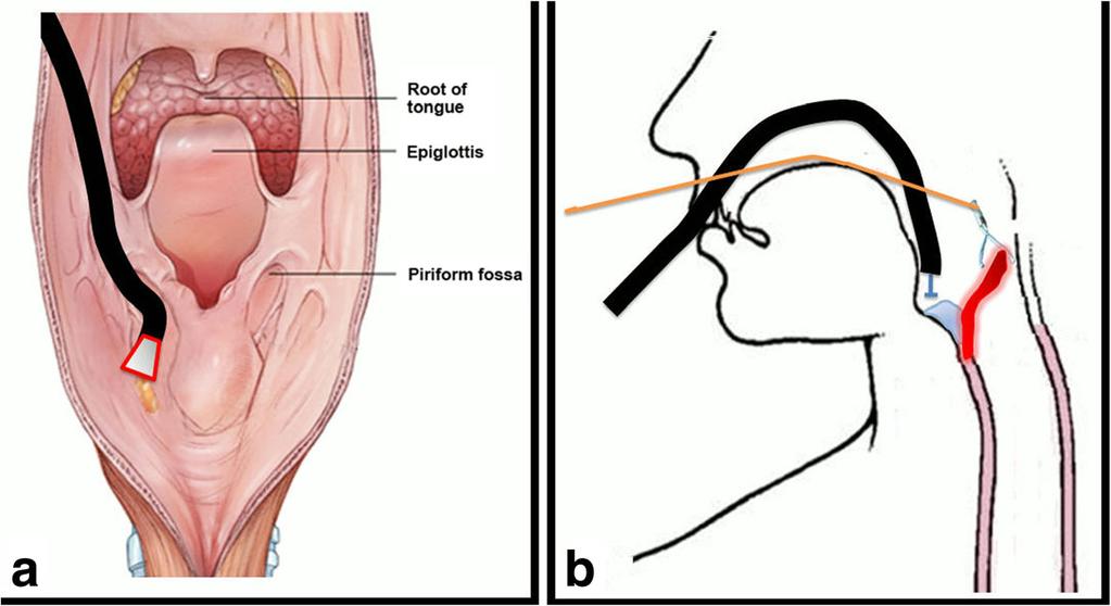 the accessory channel of the endoscope to enable insertion of the endoscope Previously, pharyngeal cancer was usually detected at advanced stages, and its prognosis has been poor [8].