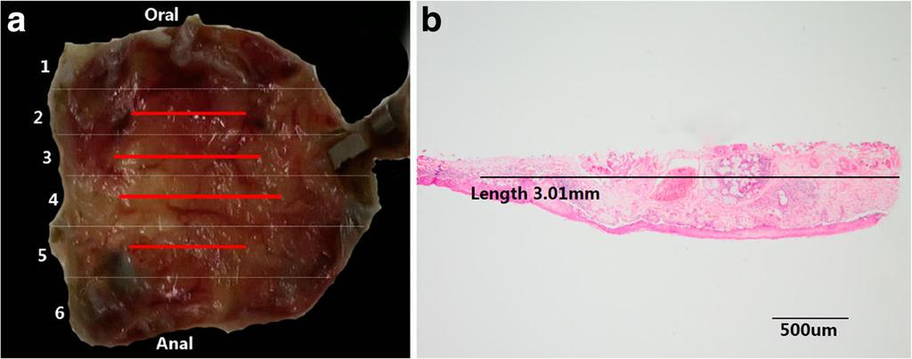 Di et al. BMC Cancer (2017) 17:712 Page 5 of 6 Fig. 6 Contrastive analysis for the resected specimen and histopathologic examination. a: The resected specimen was cut into slices at each 2 mm width.