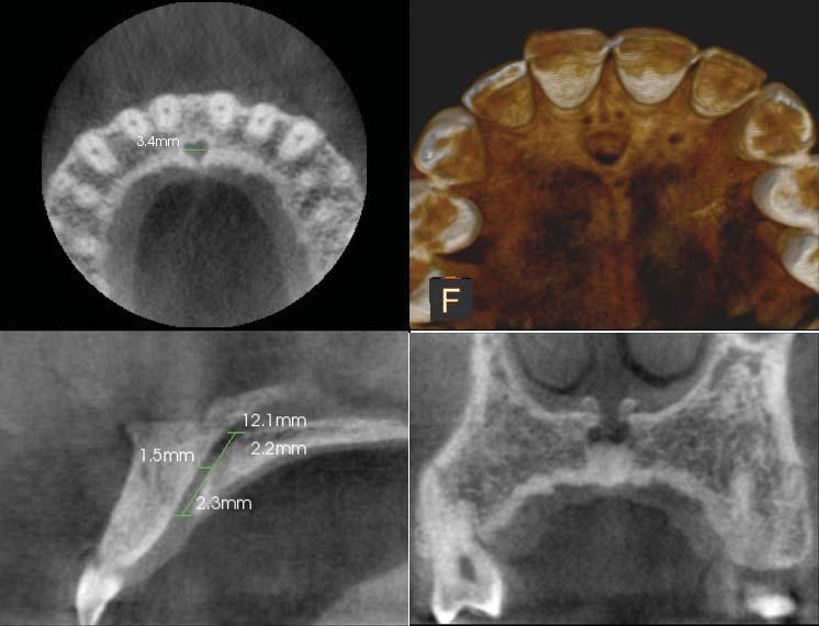 Arpita Rai Thakur et al A B C D Fig.. The nasopalatine canal on CBCT images. A. An axial section at the level of the incisive fossa shows the medio-lateral diameter of the incisive fossa. B. A three-dimensional reconstructed image of the nasopalatine canal.
