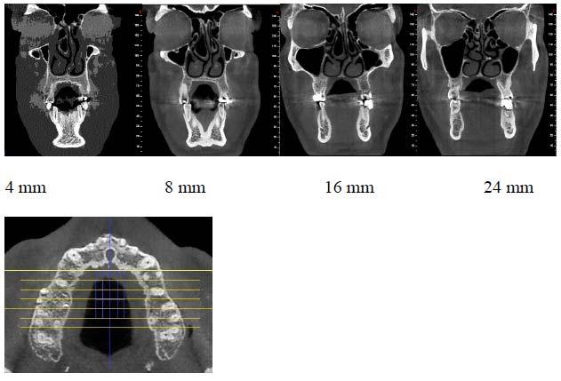 The Cone beam CT images of all the subjects were taken using a NewTom VGI Cone beam CT unit with the following specifications: 15 15-cm field of view; 110 kvp, 1-20 ma, scan time = 18 seconds and