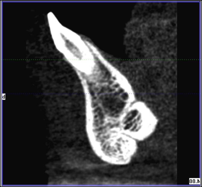 The examiners noted the presence of a lingual foramen in most patients (Figure 13).