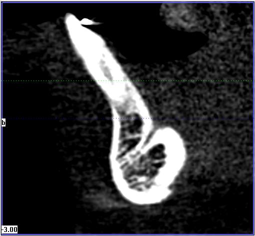 The presence of these canals may be another cause for neurosensory disturbances after implant placement.