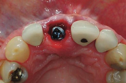 Immediate Restorations on Implants in the Esthetic Area