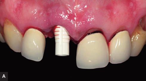 abutment is selected and seated on the implant to view