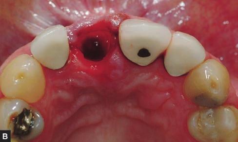 the alveolus is filled-up with Xenograft Fig.