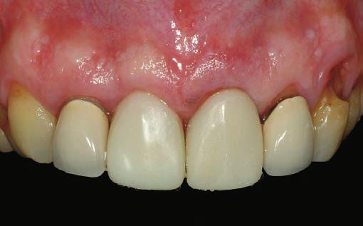 Immediate Restorations on Implants in the Esthetic Area Figs 13: Appearance of the two provisional crowns after being cemented DISCUSSION Now we know the remodeling processes of the postextraction