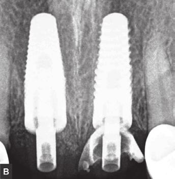 The combination of an atraumatic extraction with an implant placement immediately after the postextraction, leaves sufficient space to the alveolar table (2 mm).