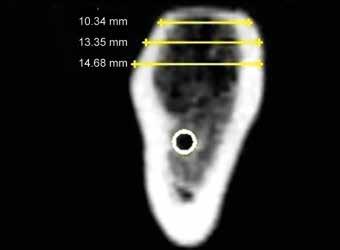 0.5 mm short of the width of the implant. With the use of the ratchet the implant is tightened in a clockwise direction.