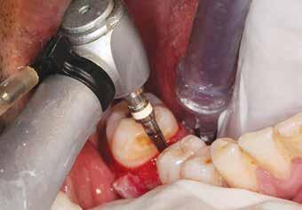 determine the changes seen at the end of healing of bone around implants