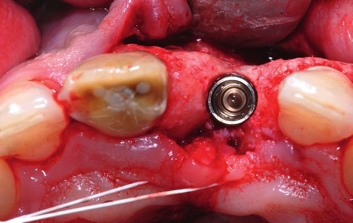 As a result of fear of the dentist, the patient continuously delayed treatment of the two teeth and wore a temporary denture with wire clasps for years.