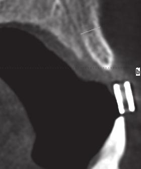 Since the incisive papilla was clinically directly in the implantation region, digital volume tomography (DVT) was performed in order to clarify the