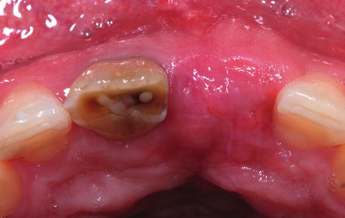 Therefore, 8 weeks after implantation, a split flap was dissected buccally in region 21 and a connective tissue